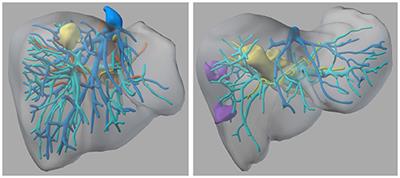 Virtual Reality for Surgical Planning – Evaluation Based on Two Liver Tumor Resections